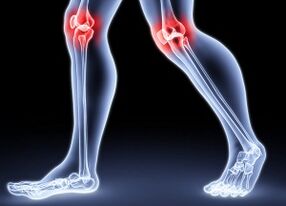Causes of the development of knee arthrosis