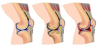 Stages of developing knee joint arthrosis