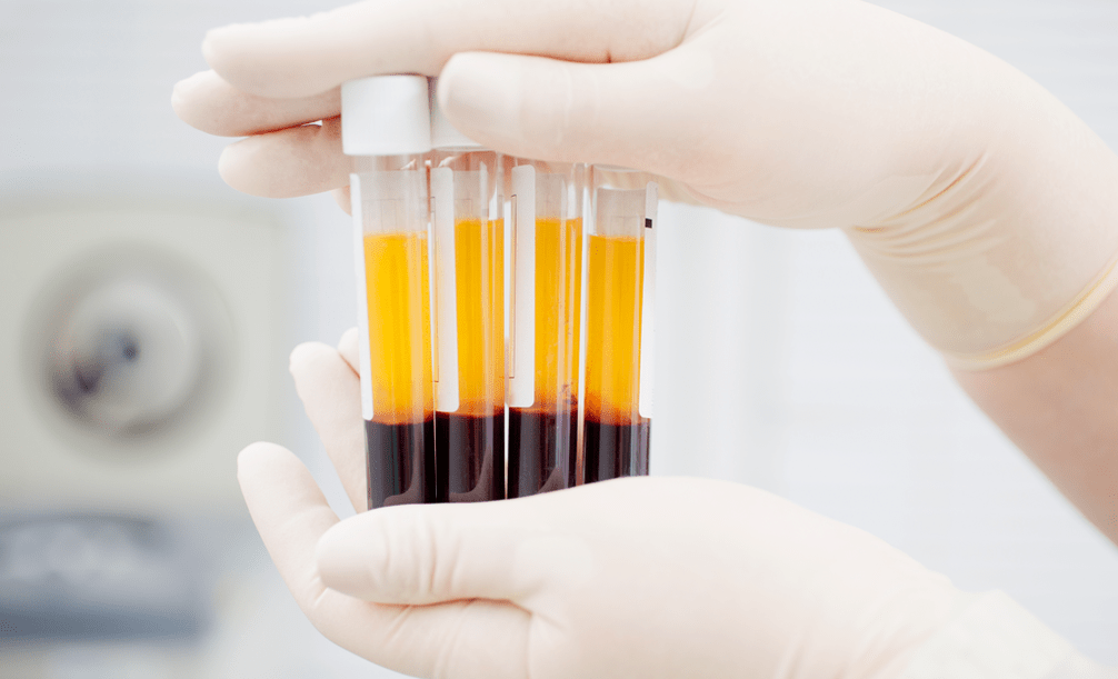 Platelet-enriched plasma for arthrosis PRP therapy